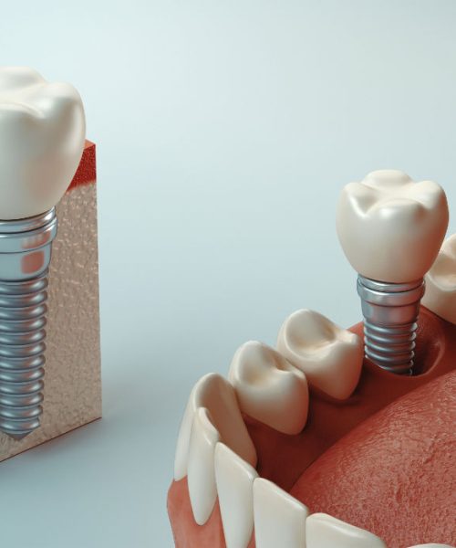 cirugia-con-implantes-dentales-luciano-badanelli-02